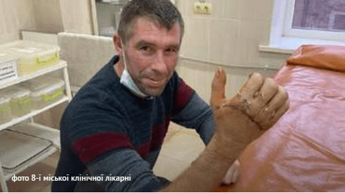 Львівські хірурги повернули чоловіку руку, яку він відрізав Львівські хірурги повернули чоловіку руку, яку він відрізав