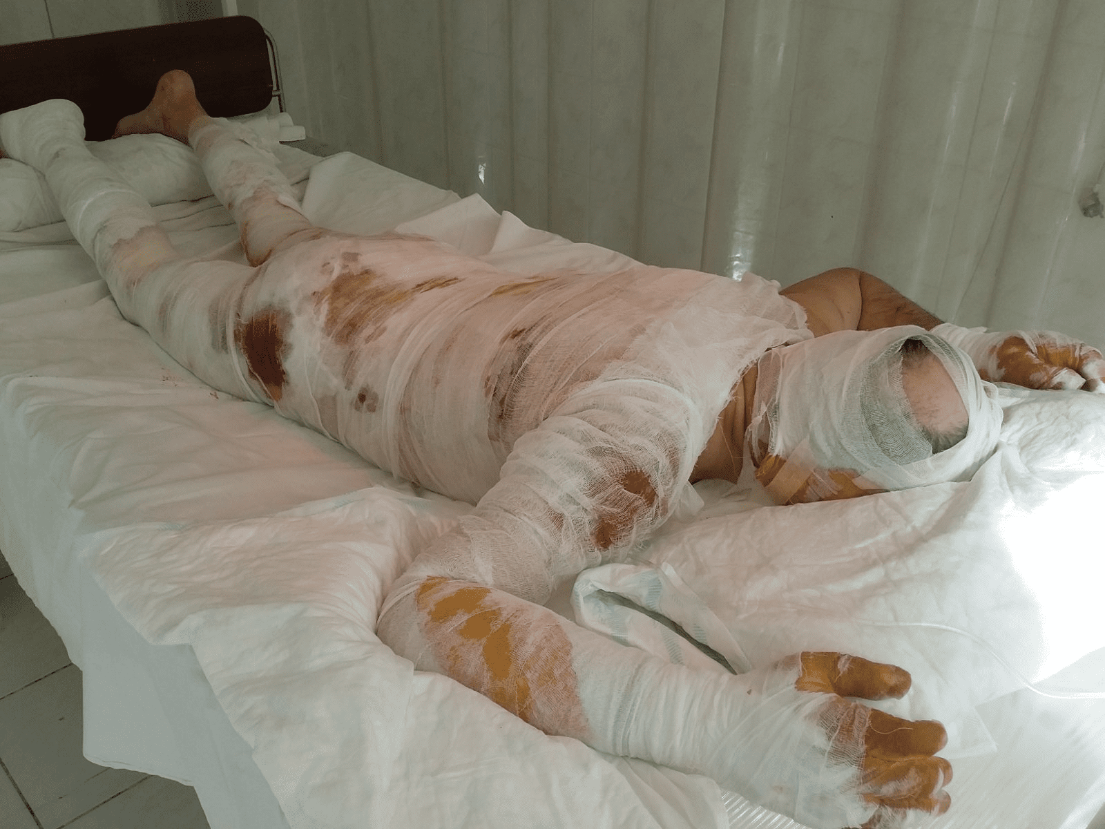 Потрібна термінова допомога жителю Рівненщини, який постраждав на пожежі