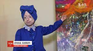 Померла єдина дитина в Україні з синдромом передчасного старіння