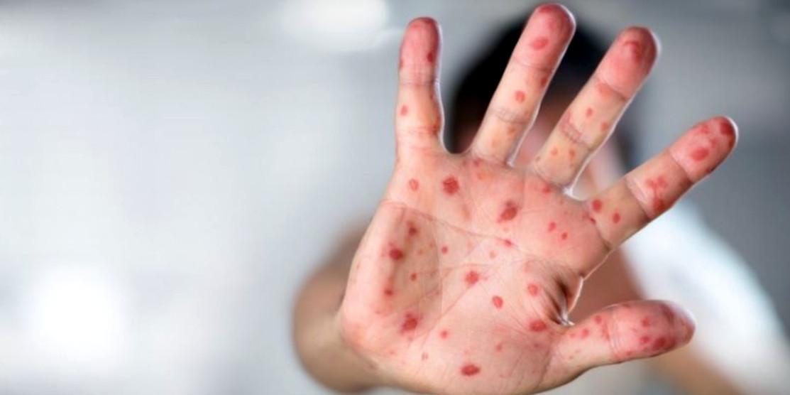 На Рівненщині розпочинається кампанія із вакцинації дітей проти кору