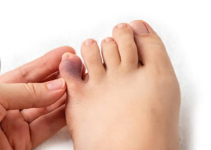 Молоткоподібна деформація пальців стопи