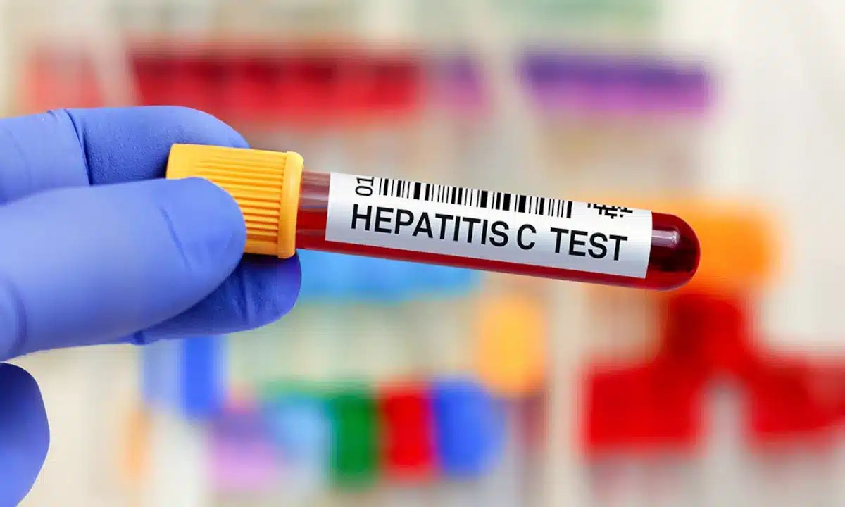 Тест на гепатити.