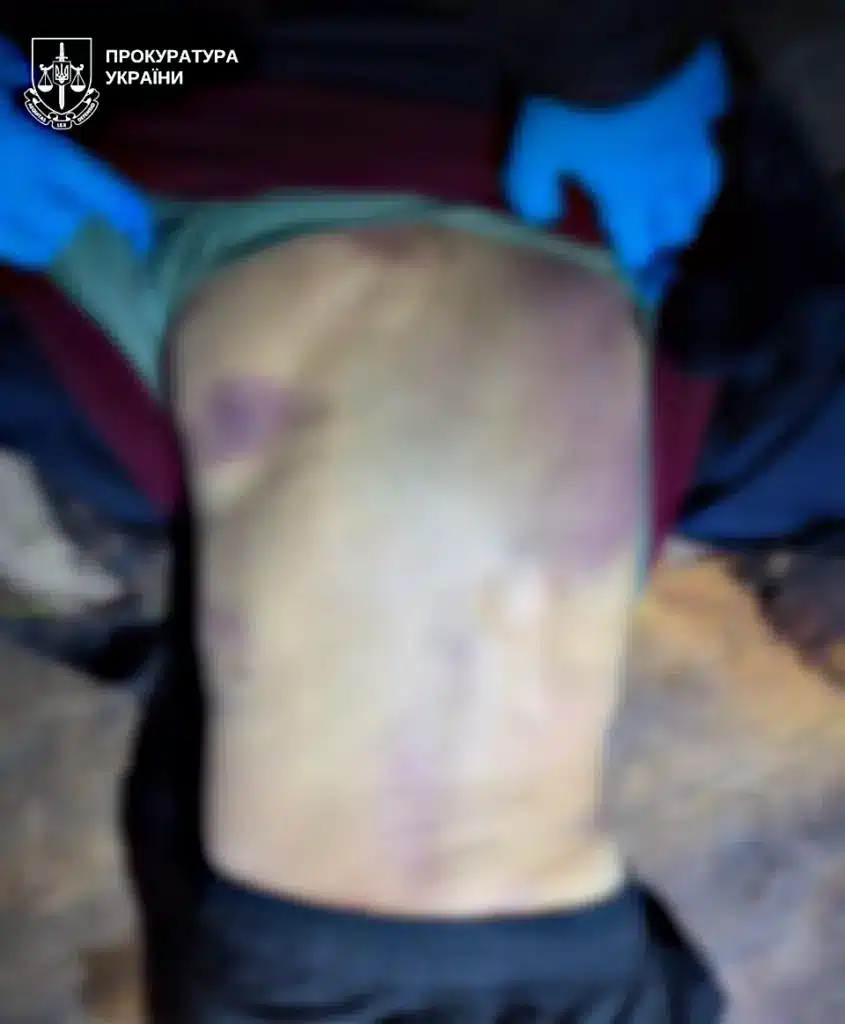 Синці на спині загиблого від побиття родичем.