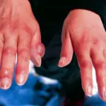 Обмороження рук.