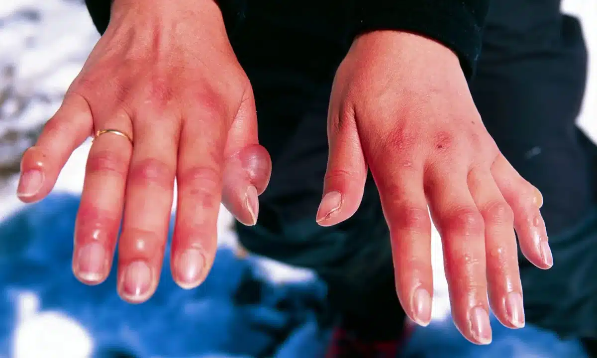 Обмороження рук.