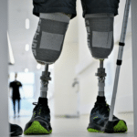 Безоплатні засоби реабілітації: що держава надає українцям Людина з протезами обох нижніх кінцівок стоїть у медичному закладі, поруч видно милиці та елементи реабілітаційного простору.