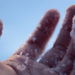 Обмороження пальців