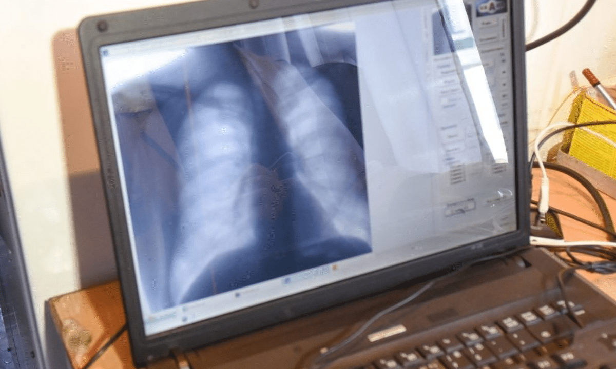 Бронхоскопія.